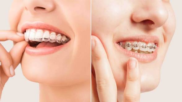 Orthodontic clear aligners and dental braces