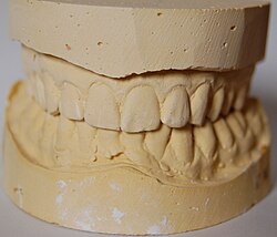 Dental impressions plaster cast model for dental restorations