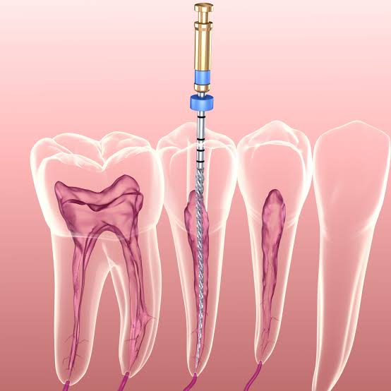 Endodontic root canal therapy procedure diagram