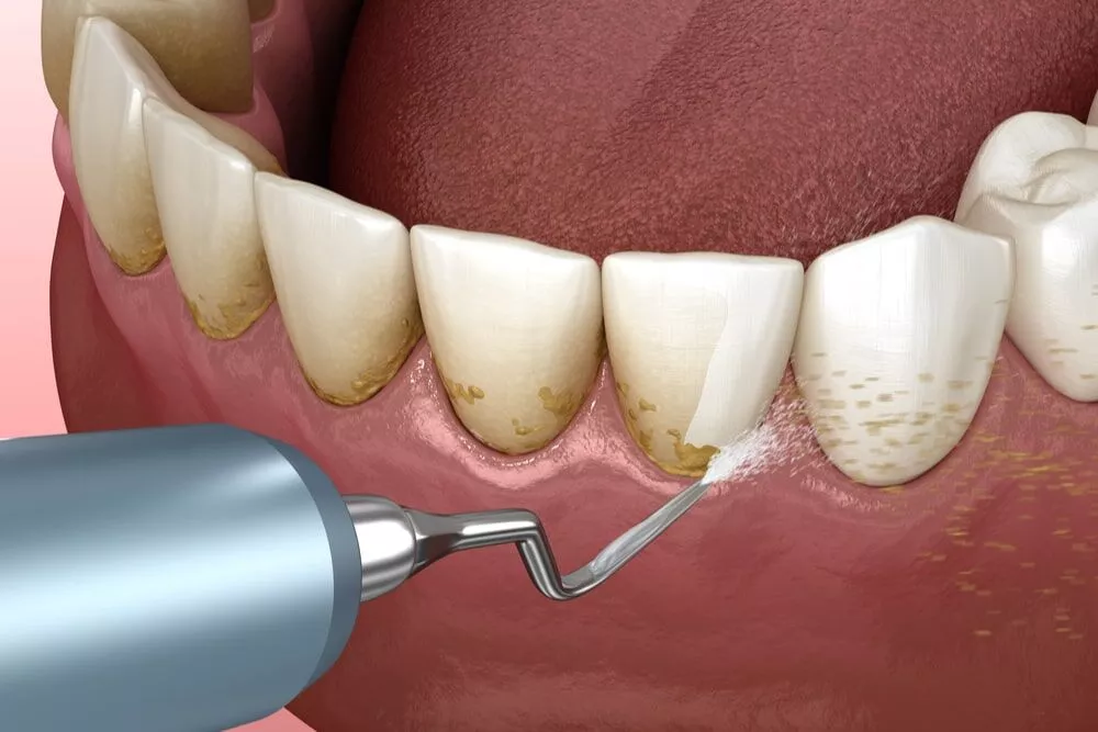 Ultrasonic dental scaling and teeth cleaning procedure